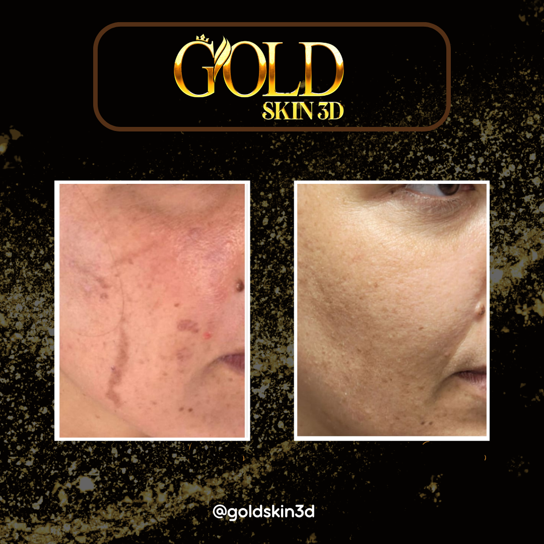 PROTOCOLO GOLD SKIN 3D