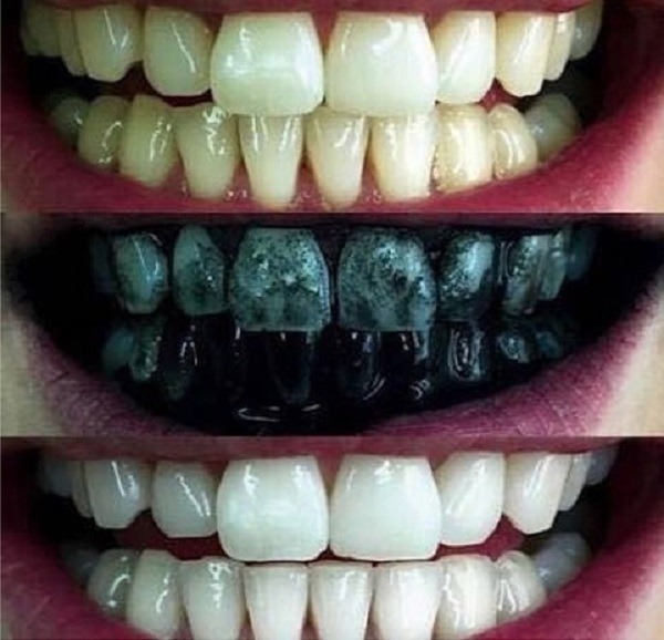 Dental clareamento