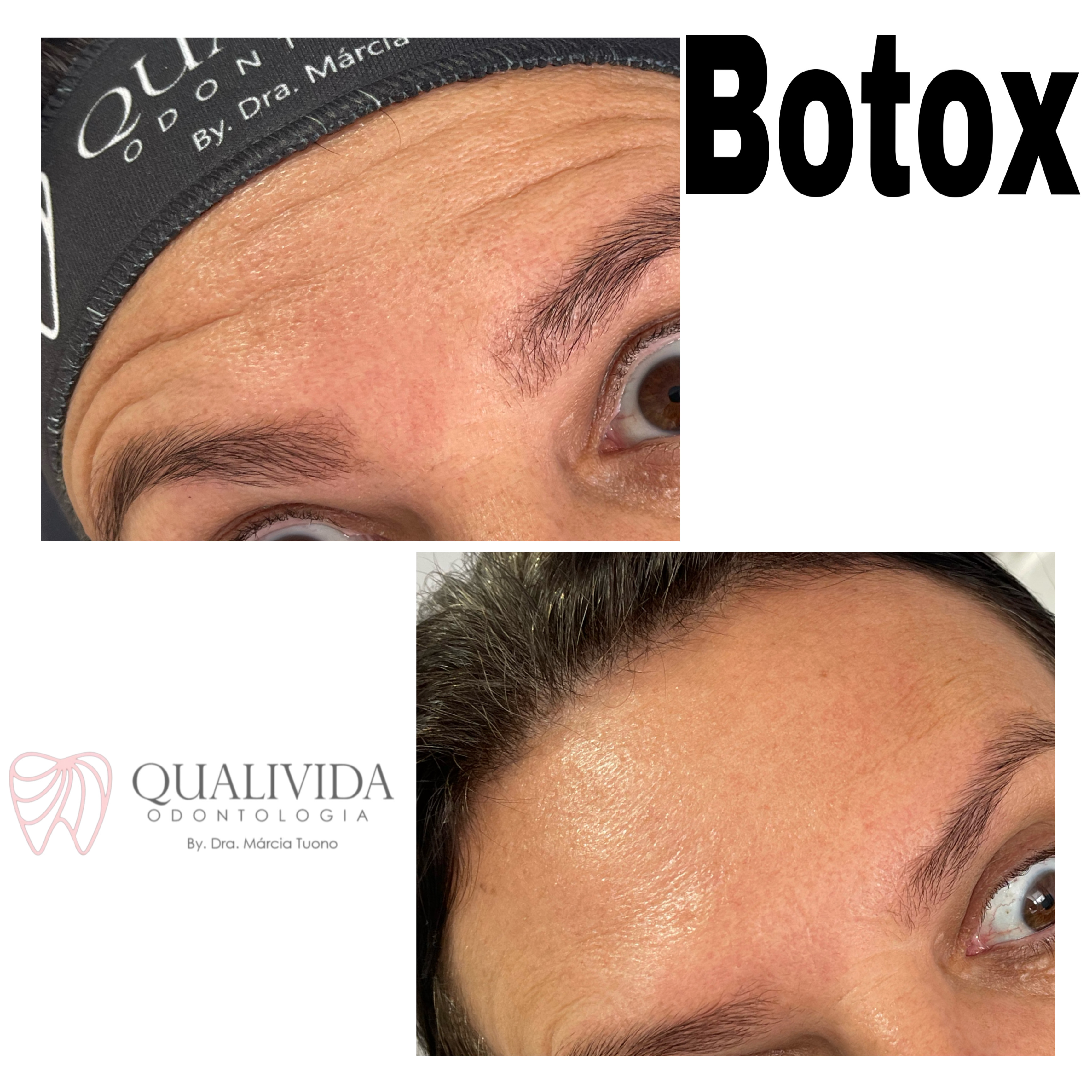 Curso Prático de Toxina Botulínica