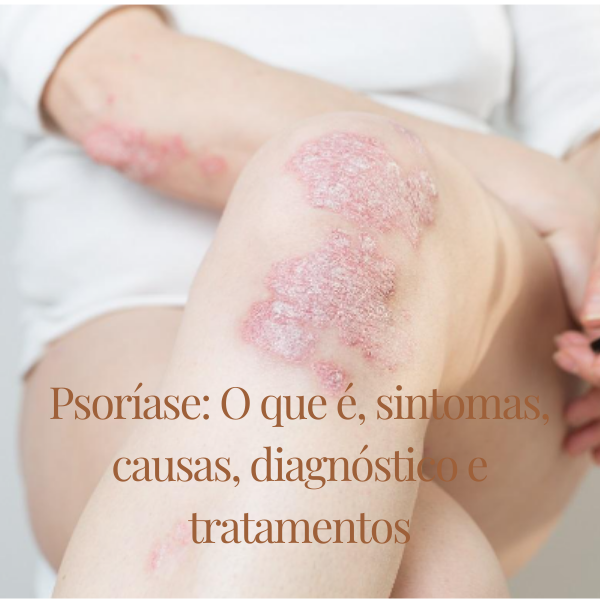 Psoríase: O que é, sintomas, causas, diagnóstico e tratamentos - Ni...