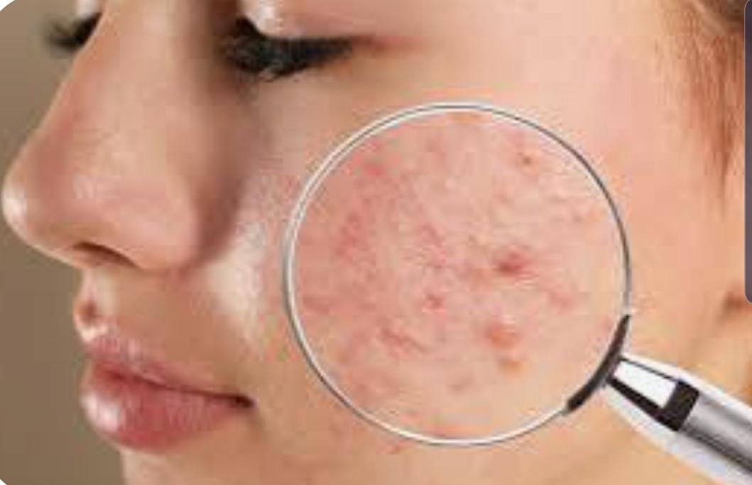 ACNE FILL Peeling Quimico Anti Acne Renovador - Cristiane C. dos Sa...