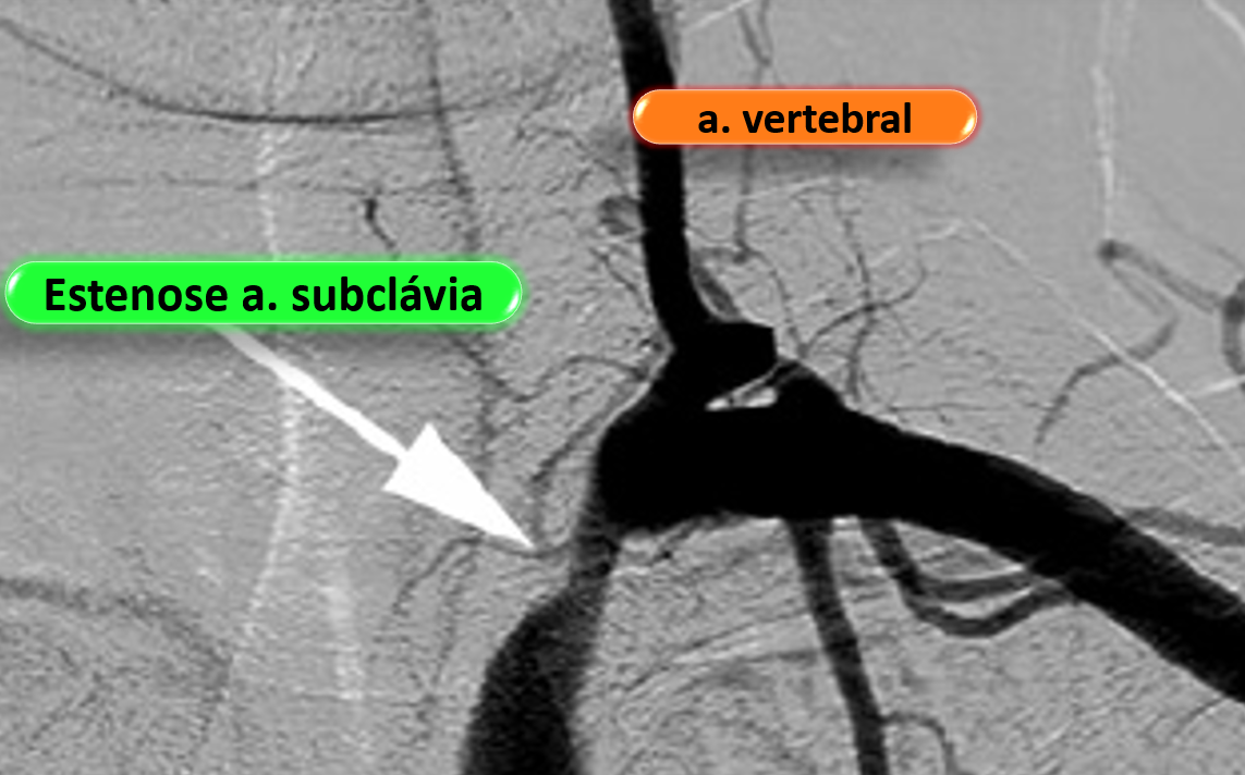 Ultrassom Vascular com Doppler - Roubo da artéria subclávia - Silfa...