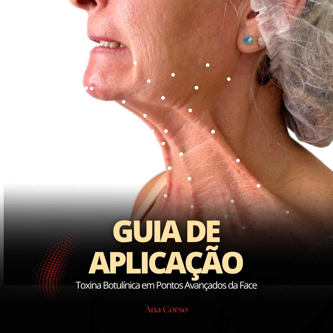 Guia de Aplicação Toxina Botulínica em Pontos Avançados da Face - A...