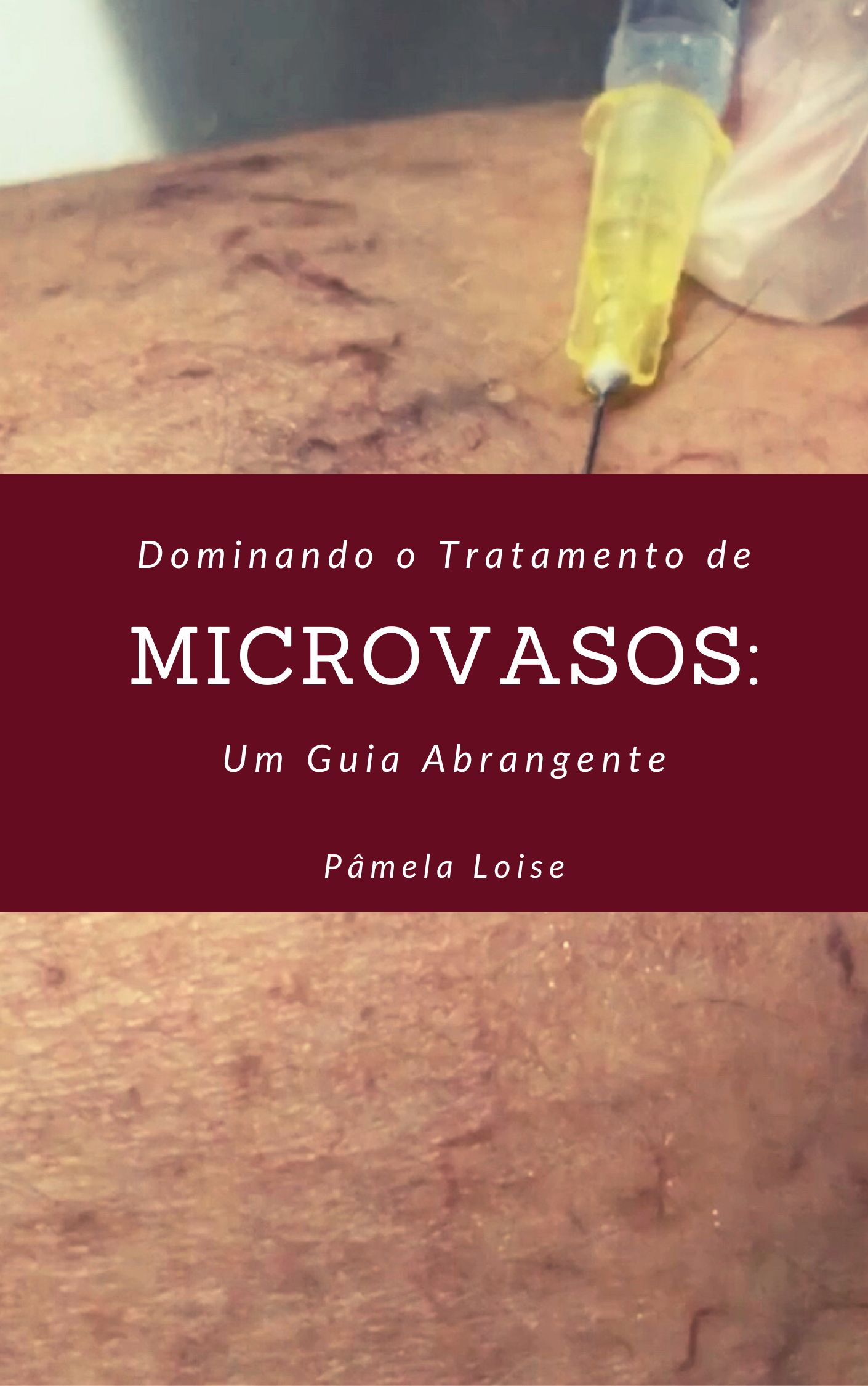 Dominando o Tratamento de Microvasos: Um Guia Abrangente (PEIM) - P...