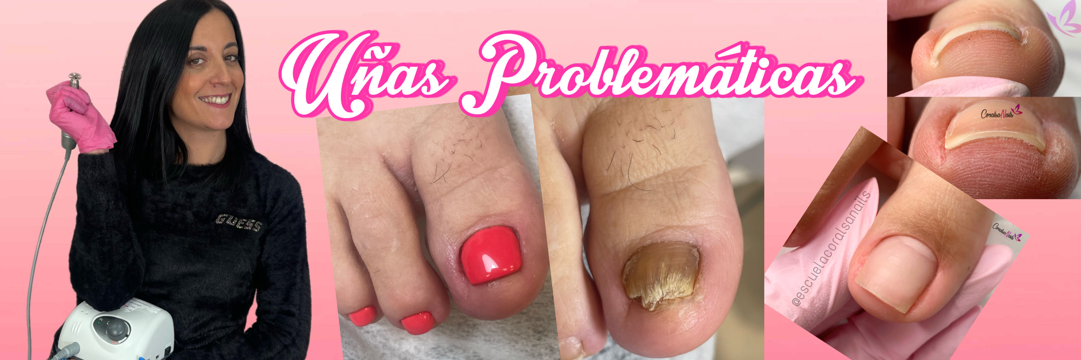 Curso Pedicura Profesional Uñas Problemáticas de CoralSanais