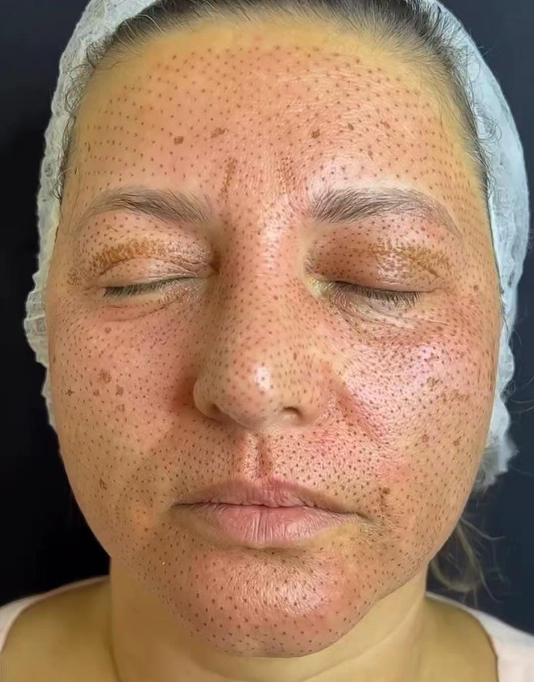 Imagem de capa para o Curso online Full Face Jato de Plasma